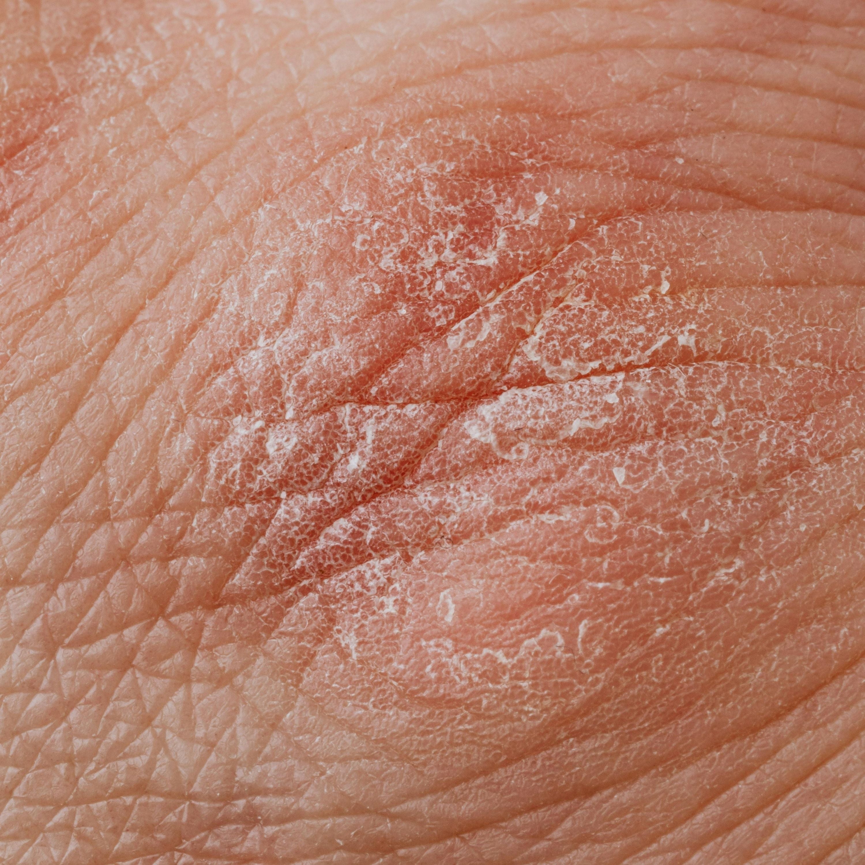 Eczéma : comprendre et prendre soin de sa peau au naturel